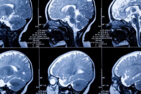 Yenidoğanlarda Beyin Hasarı Erken Tespit Edilebilir yöntemiyle mümkün - Dakikada Haber Yenidoğanlarda Beyin Hasarı Erken Tespit Edilebilir yöntemiyle mümkün